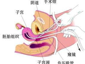 流产手术需要休息多长时间？